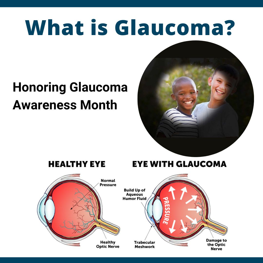 Understanding Glaucoma Causes, Symptoms, and Treatment