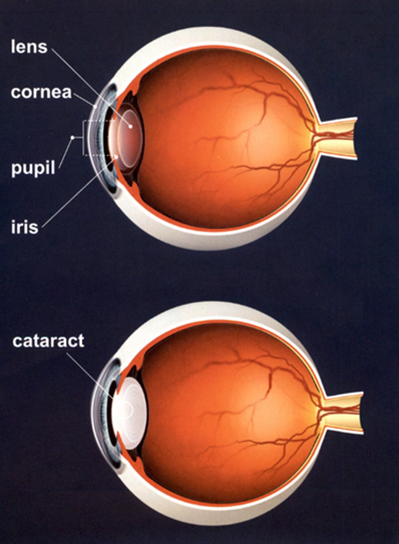 cataract diagram showing two eyeballs