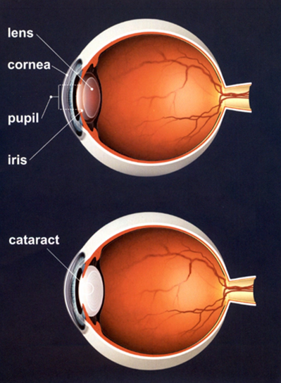 cataract-diagram.png cataract diagram showing two eyeballs